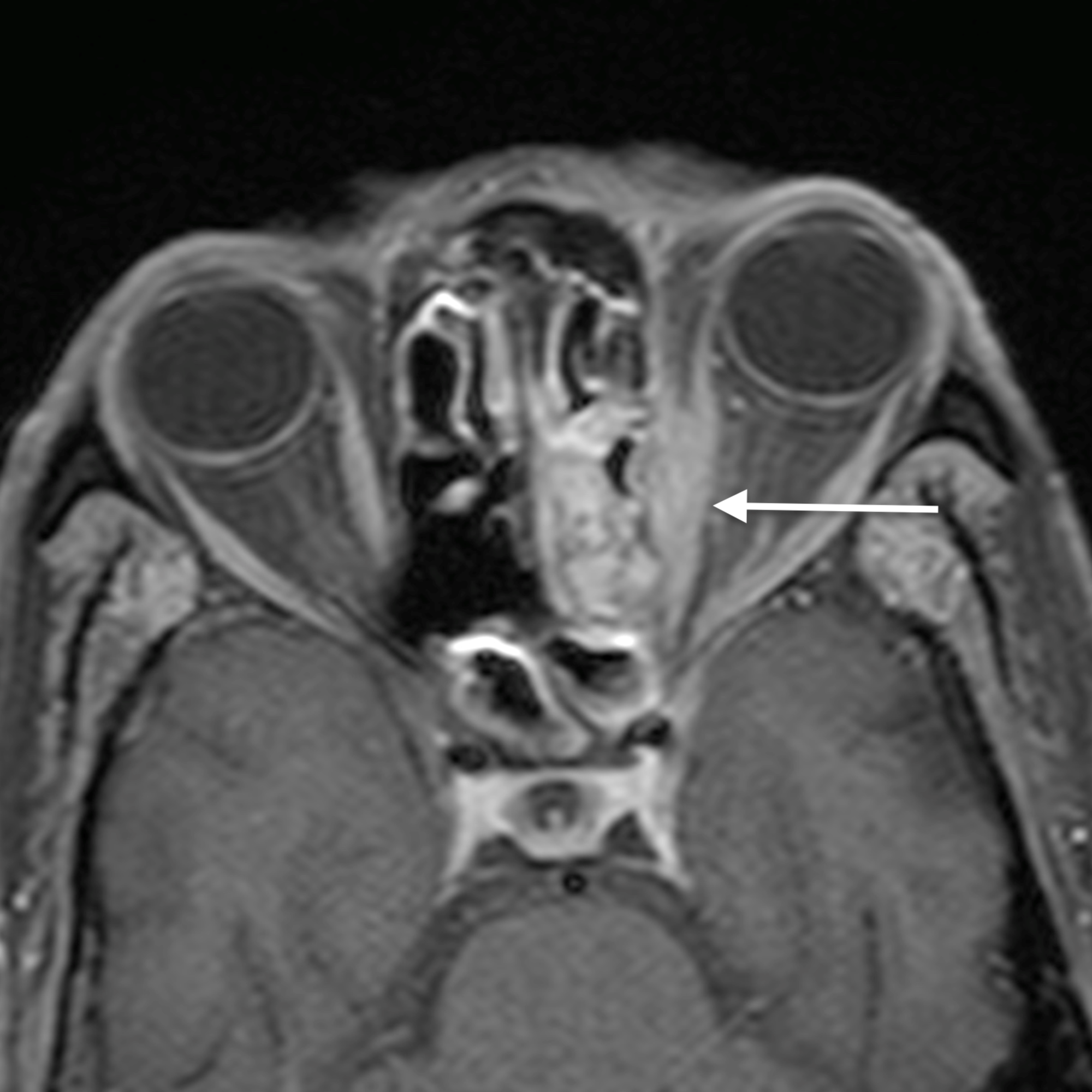 Cureus Spectrum Of Orbital Cellulitis On Magnetic Resonance Imaging