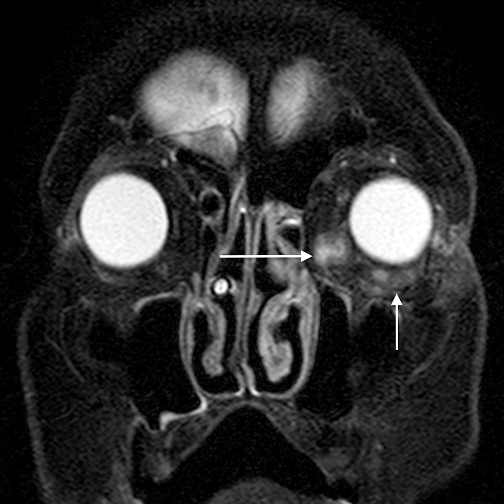 Orbital-abscess:-coronal-STIR-image-shows-two-well-defined-hyperintense-lesions-(arrows)-in-the-intraconal-and-extraconal-compartments-of-left-orbit-in-the-inferior-and-medial-aspects