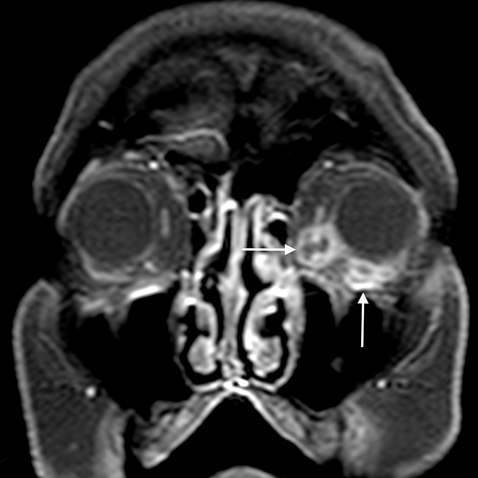 Orbital-abscess:-coronal-post-gadolinium-T1WI-shows-peripheral-enhancement-of-the-lesions-(arrows),-indicative-of-abscess