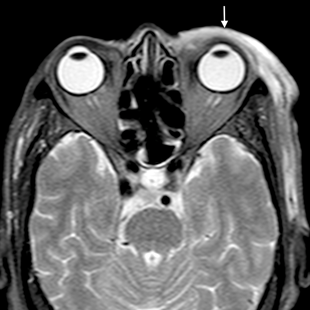 Preseptal-cellulitis-with-abscess:-axial-STIR-image-shows-abnormal-hyperintense-signal-in-the-preseptal-region-in-subcutaneous-plane