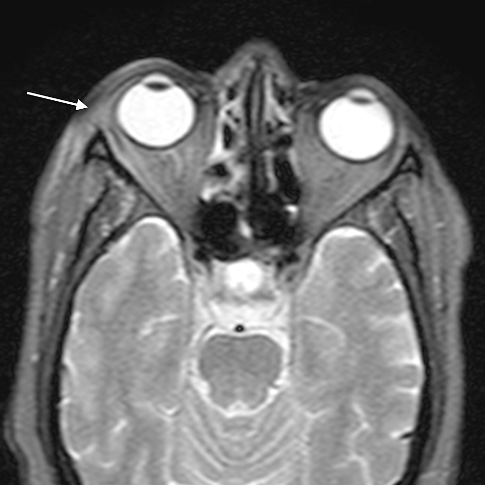 Periorbital-cellulitis:-axial-STIR-image-shows-preseptal-soft-tissue-thickening-on-right-with-hyperintense-signal-(arrow)-involving-the-preseptal-region-and-extending-in-the-infratemporal-fossa
