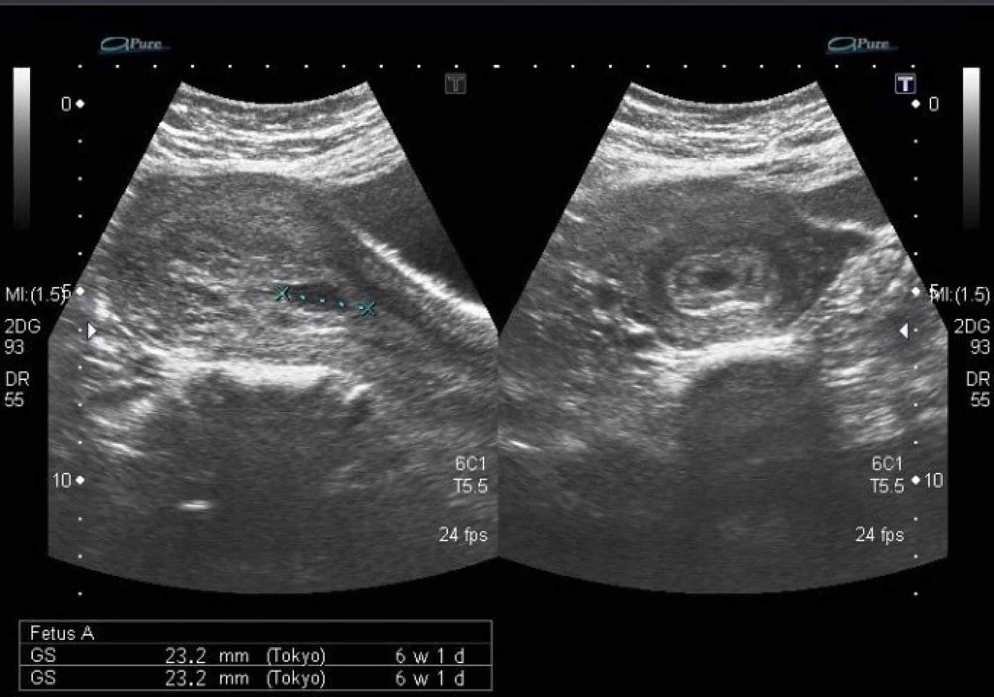 Cureus | A Case Series on Uterine Arteriovenous Malformations: A Life ...