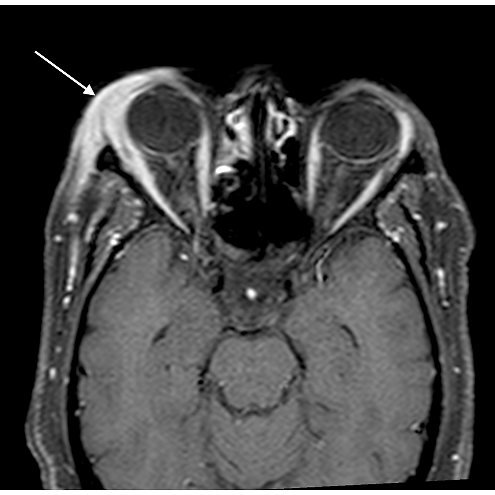 Periorbital-cellulitis:-axial-post-gadolinium-T1WI-shows-abnormal-enhancement-of-the-preseptal-soft-tissue-thickening-(arrow)-and-extending-in-the-infratemporal-fossa