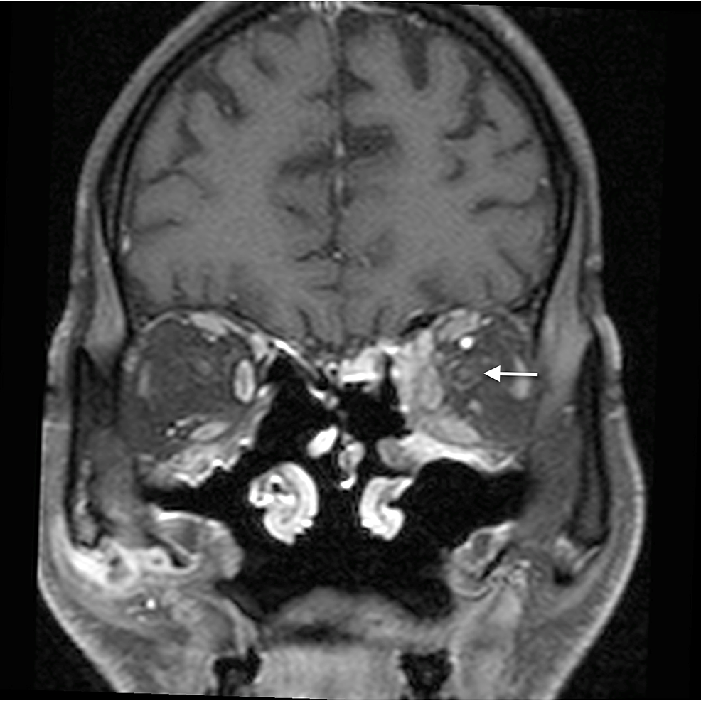 Optic-perineuritis:-coronal-post-gadolinium-T1WI-shows-mild-perineural-enhancement-around-the-left-optic-nerve-(arrow),-indicative-of-optic-perineuritis.-Enhancement-is-also-noted-in-the-extraconal-compartment-medially,-suggestive-of-orbital-cellulitis