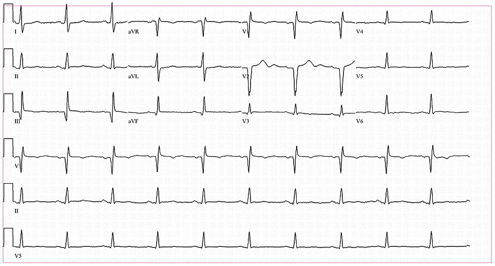 ivcd consider atypical rbbb