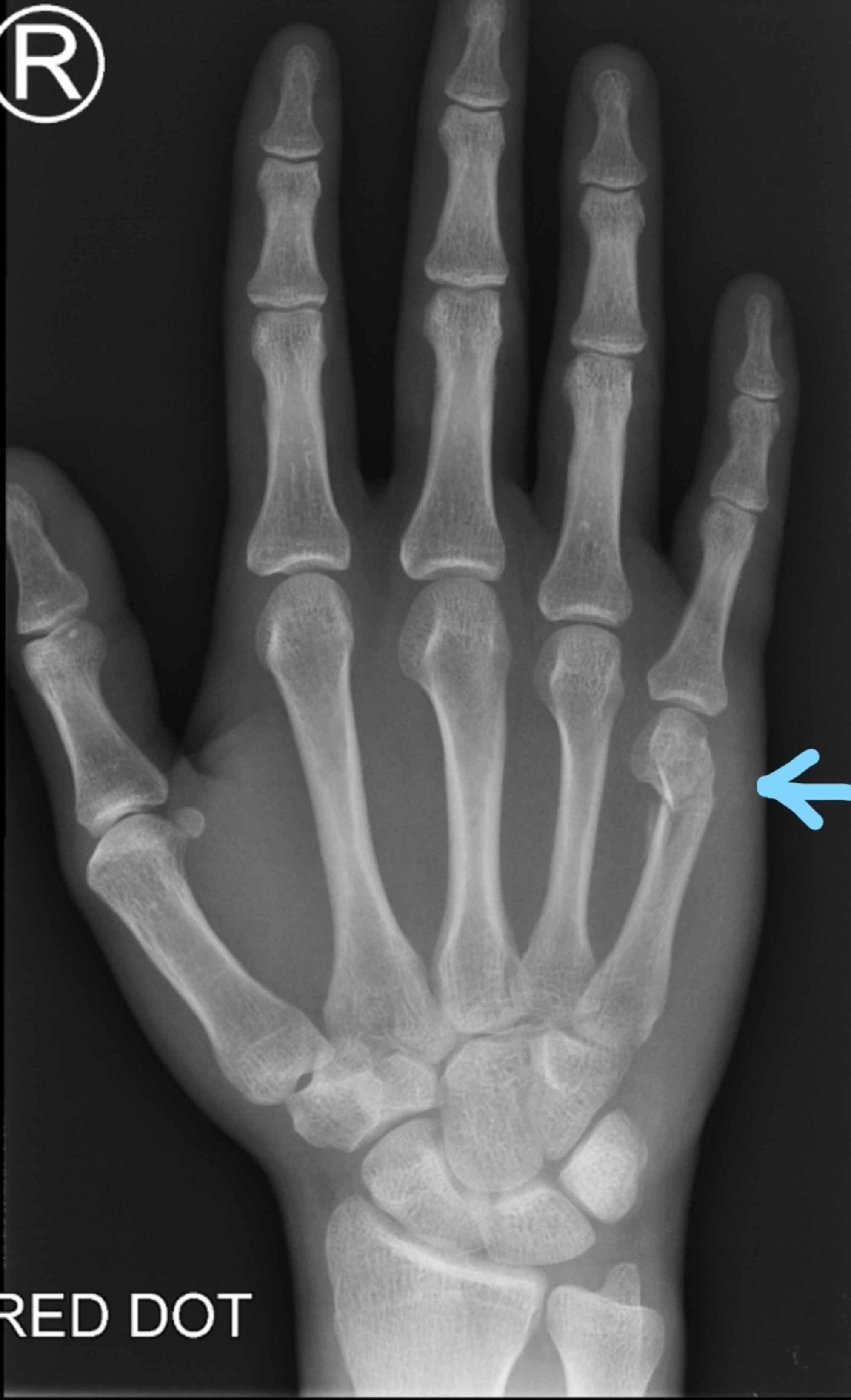 5th metacarpal fracture surgery cost