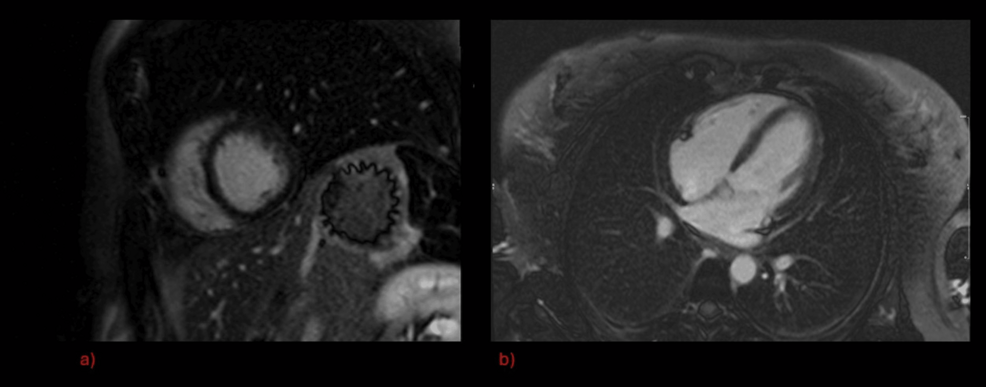 Gadolinium-enhanced-cardiac-MRI-during-first-in-patient-episode Gadolinium-enhanced-cardiac-MRI-during-first-in-patient-episode