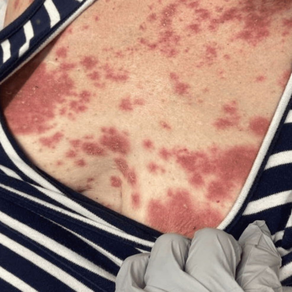 Acute Generalized Exanthematous Pustulosis in a Patient With Crohn's Disease Being ... - Cureus