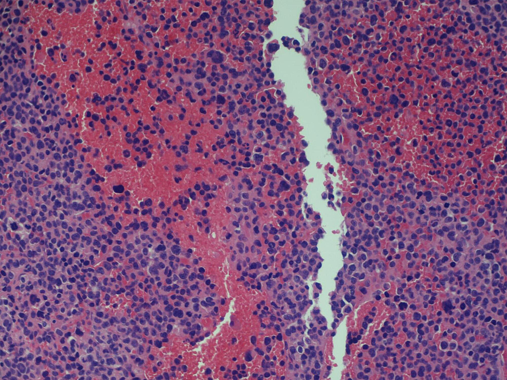 Hypercellular-bone-marrow-with-90%-involvement-by-plasma-cells