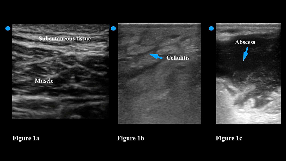 Introduction to First-Trimester Point-of-Care Ultrasound - Point-of-Care  Ultrasound Certification Academy