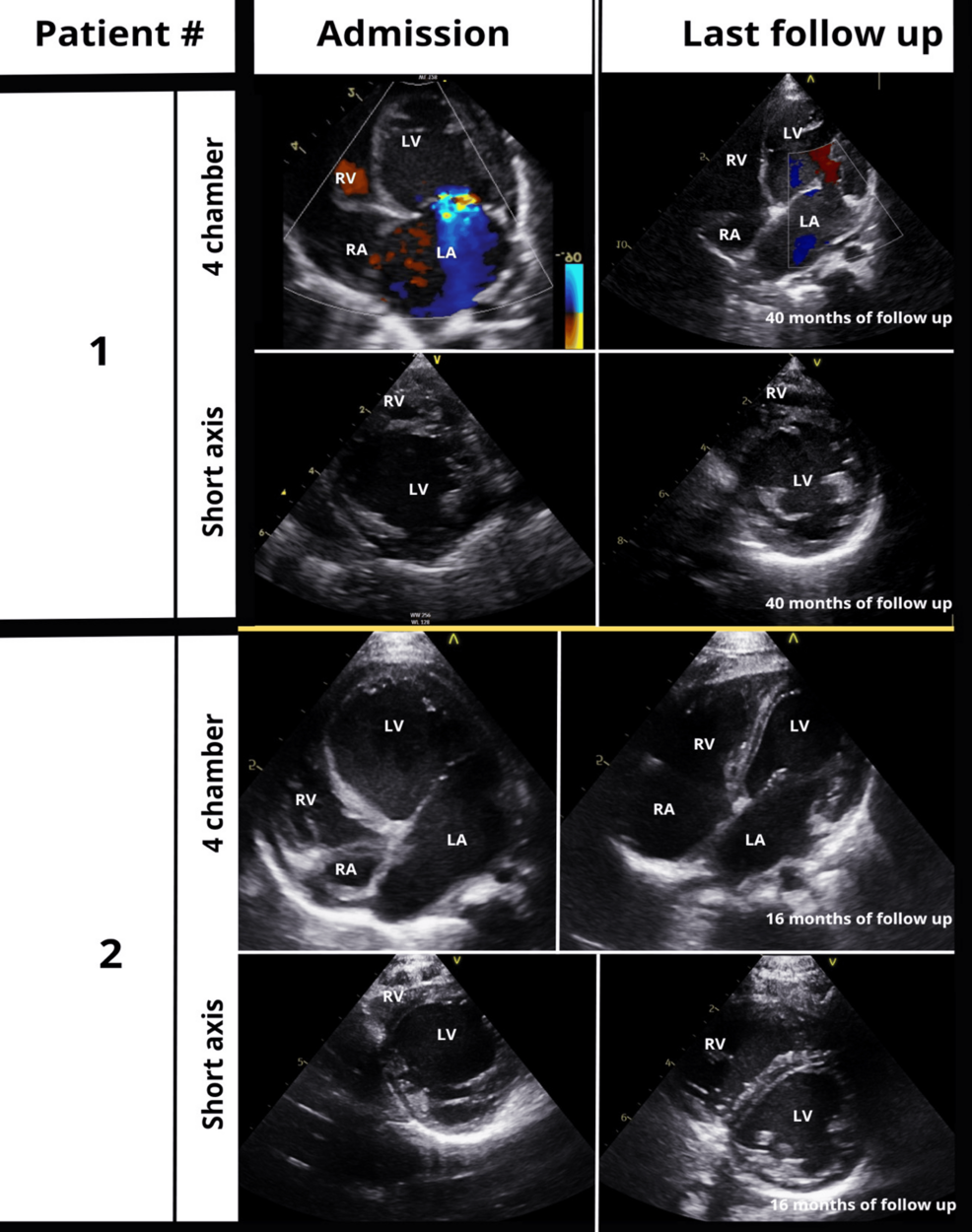 l carnitine depression reddit Infantile Dilated Cardiomyopathy in Alström Syndrome