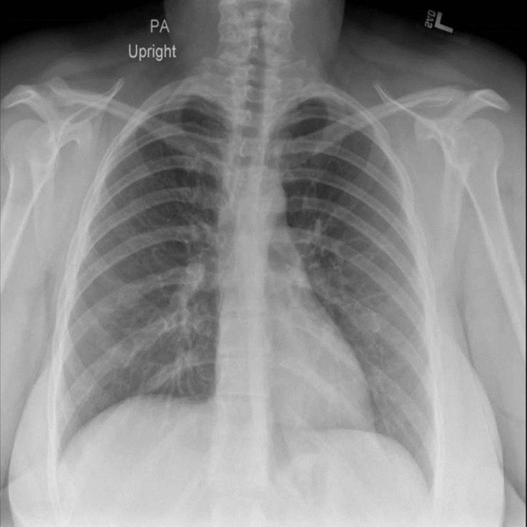 Cureus | Pulmonary Symptoms as the First Manifestation of Crohn’s Disease