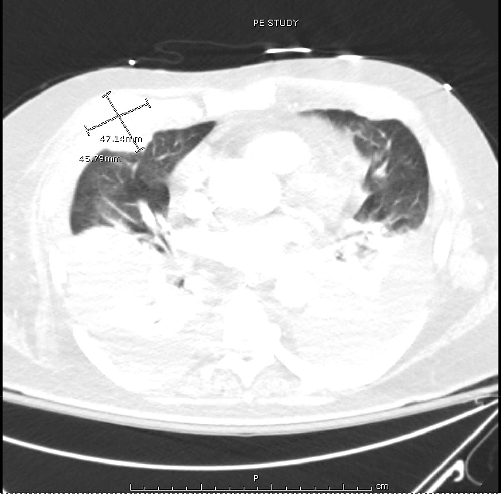 Computed-tomography-(CT)-of-chest-showing-widespread-lobulated-masses-present-bilaterally,-largest-measuring-4.6-x-4.7-cm-in-the-right-mid-chest-with-bilateral-pleural-effusions-causing-severe-compressive-atelectasis
