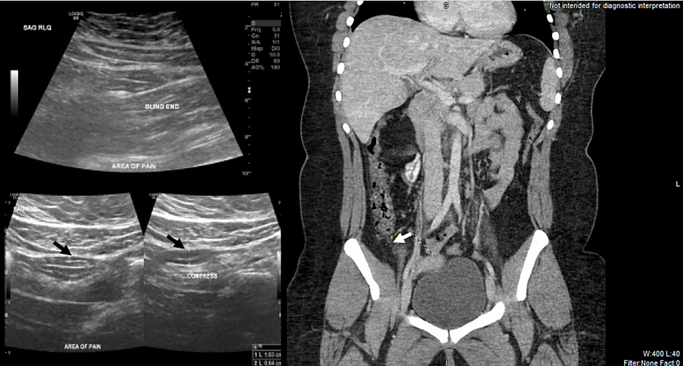 Ultrasound-(left)-shows-non-compressible-appendix-(black-arrow)-and-CT-(right)-shows-normal-appendix-(white-arrow)
