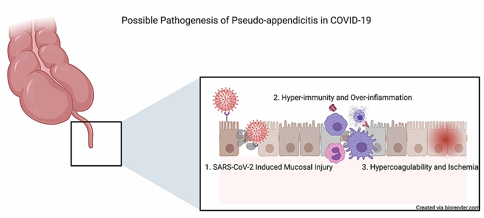 Proposed-mechanisms-of-COVID-19-induced-pseudo-appendicitis-