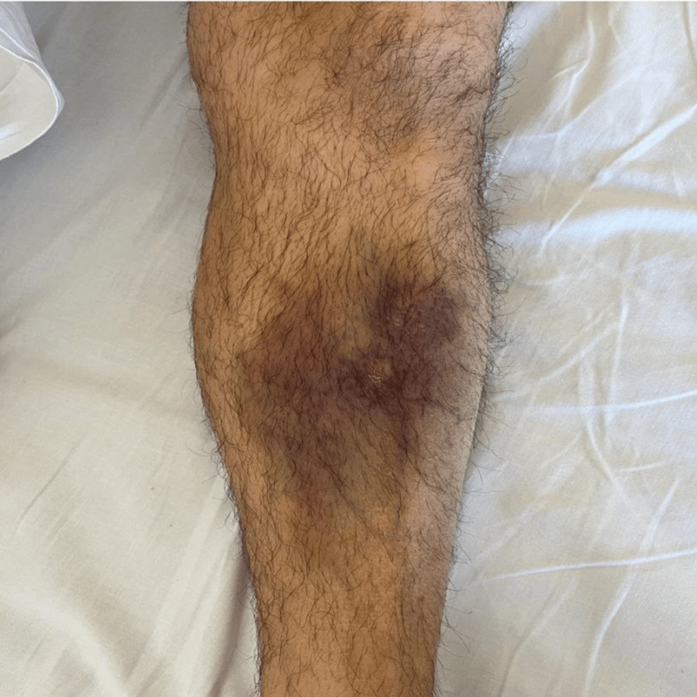 B-cell Acute Lymphoblastic Leukemia in a Patient With Crohn's Disease After Anti-TNF ...