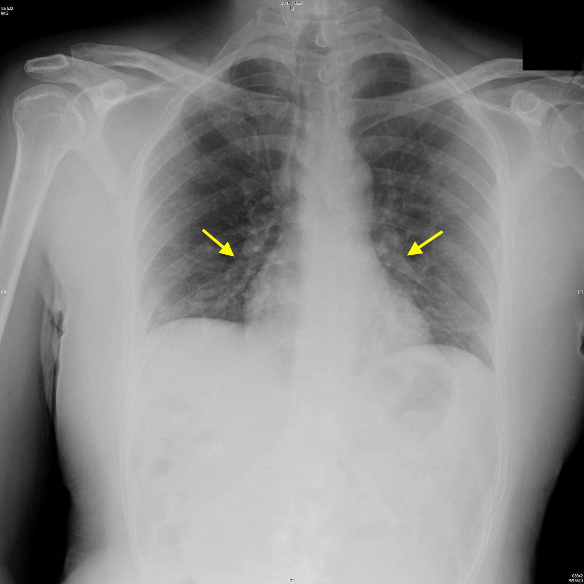 bacterial pneumonia chest x ray findings