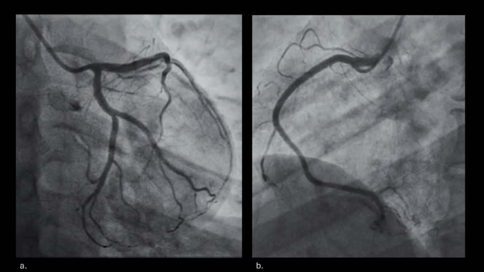 Invasive-coronary-angiogram. Invasive-coronary-angiogram.
