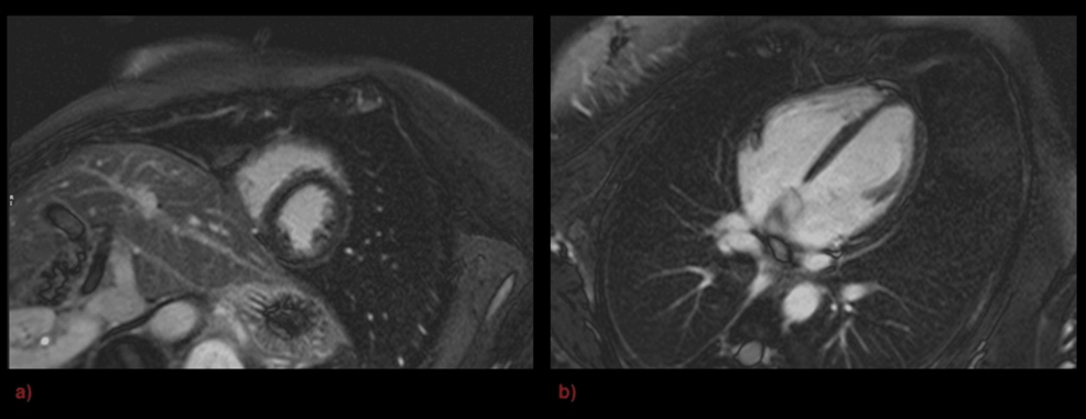 Repeat-gadolinium-enhanced-cardiac-MRI- Repeat-gadolinium-enhanced-cardiac-MRI-