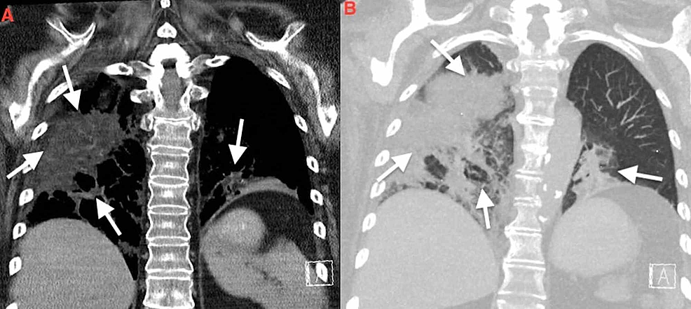 Aspiration pneumonia, Radiology Reference Article