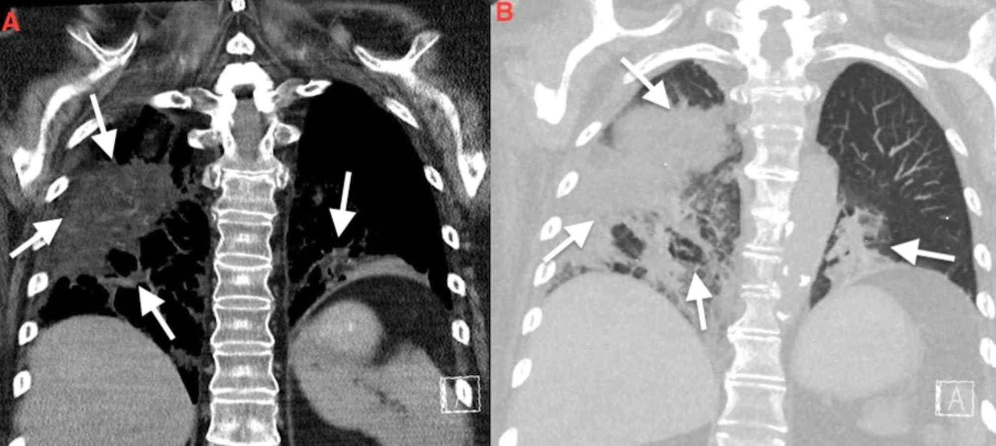 Cureus | Exogenous Lipoid Pneumonia Complicated by Mineral Oil Aspiration  in a Patient With Chronic Constipation: A Case Report and Review | Article