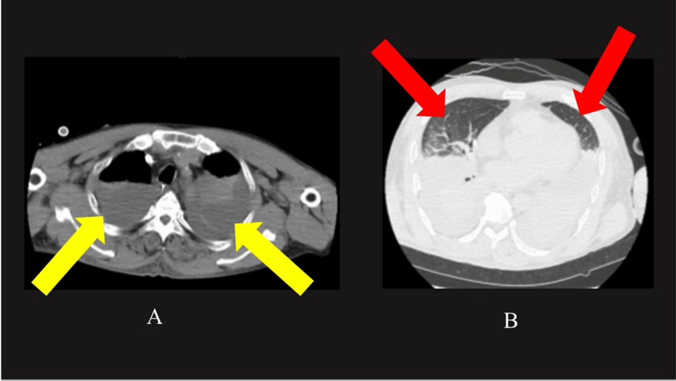 Plain-CT-of-the-lung-taken-after-the-introduction-of-ECMO Plain-CT-of-the-lung-taken-after-the-introduction-of-ECMO