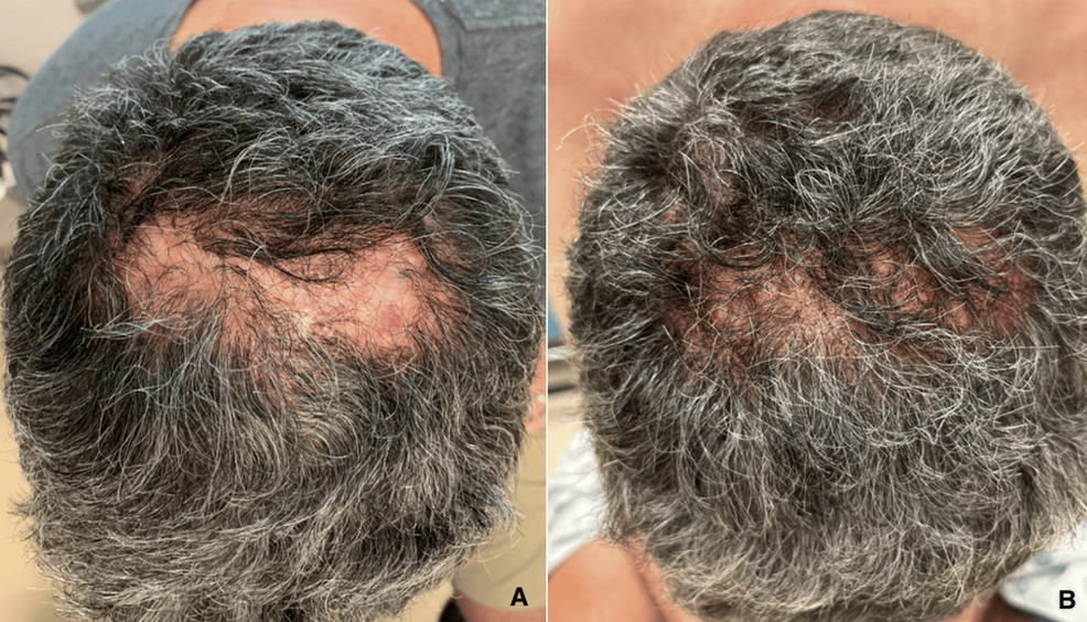tirzepatide skin sensitivity reddit Improvement of Recalcitrant Folliculitis Decalvans With Tirzepatide: A Case  Report