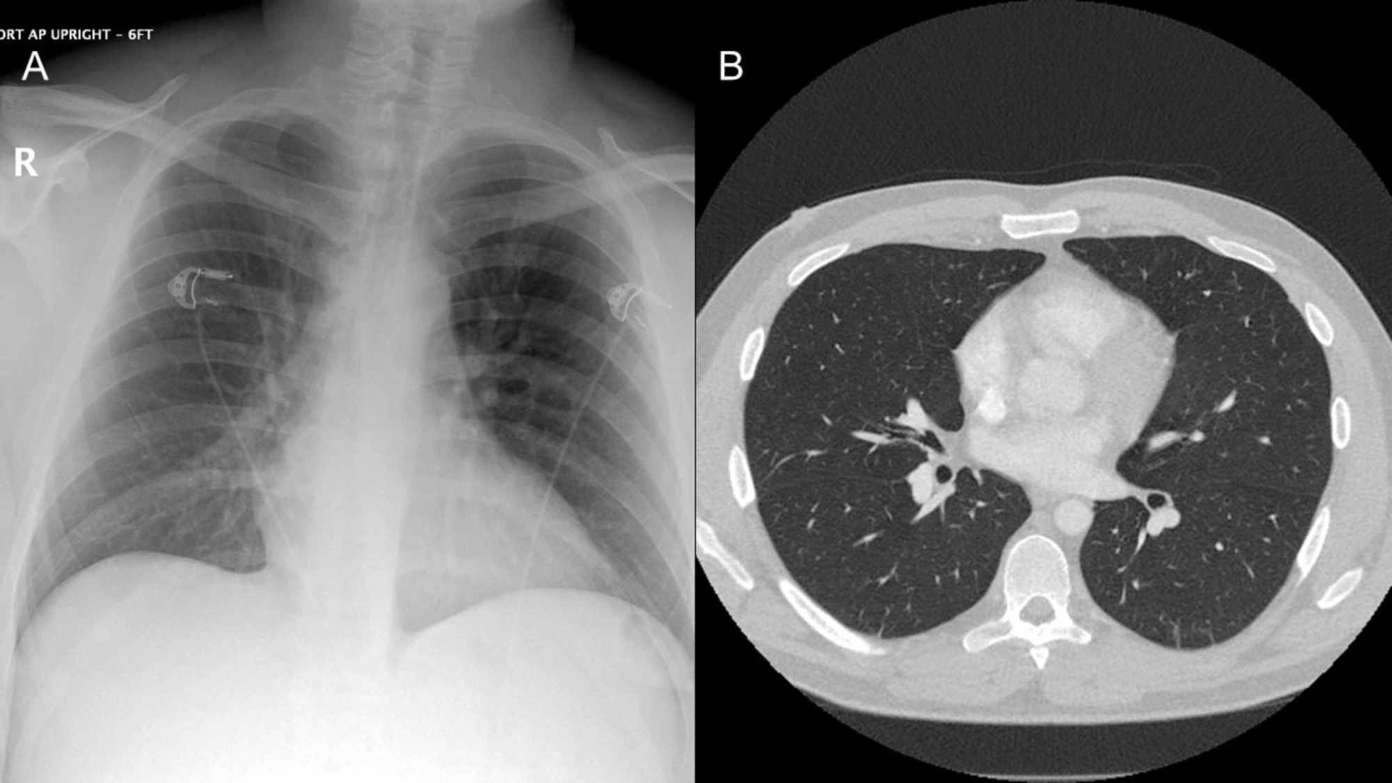 Cureus Concurrent Diagnosis of Acute Myeloid Leukemia and COVID19 A