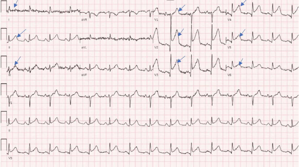 Myocardial Bridging, Ischemia & Takotsubo: A Rare Case Study - News Directory 3