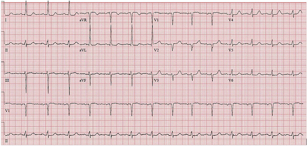 Cureus | Differentiating Pseudohyperkalemia From True Hyperkalemia in a ...