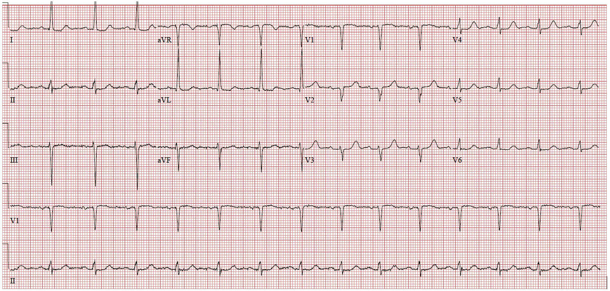 Cureus | Differentiating Pseudohyperkalemia From True Hyperkalemia in a ...