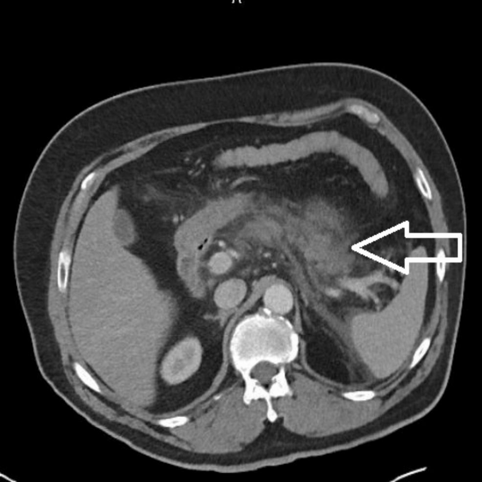 does tirzepatide target belly fat Does Tirzepatide Burn Fat?