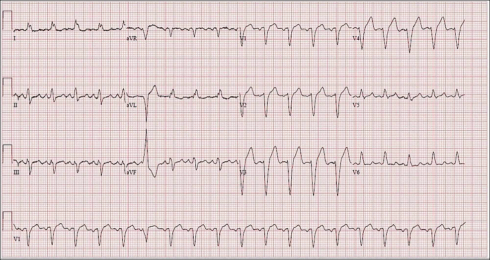 Cureus | Atypical Presentation of Spontaneous Coronary Artery Dissection