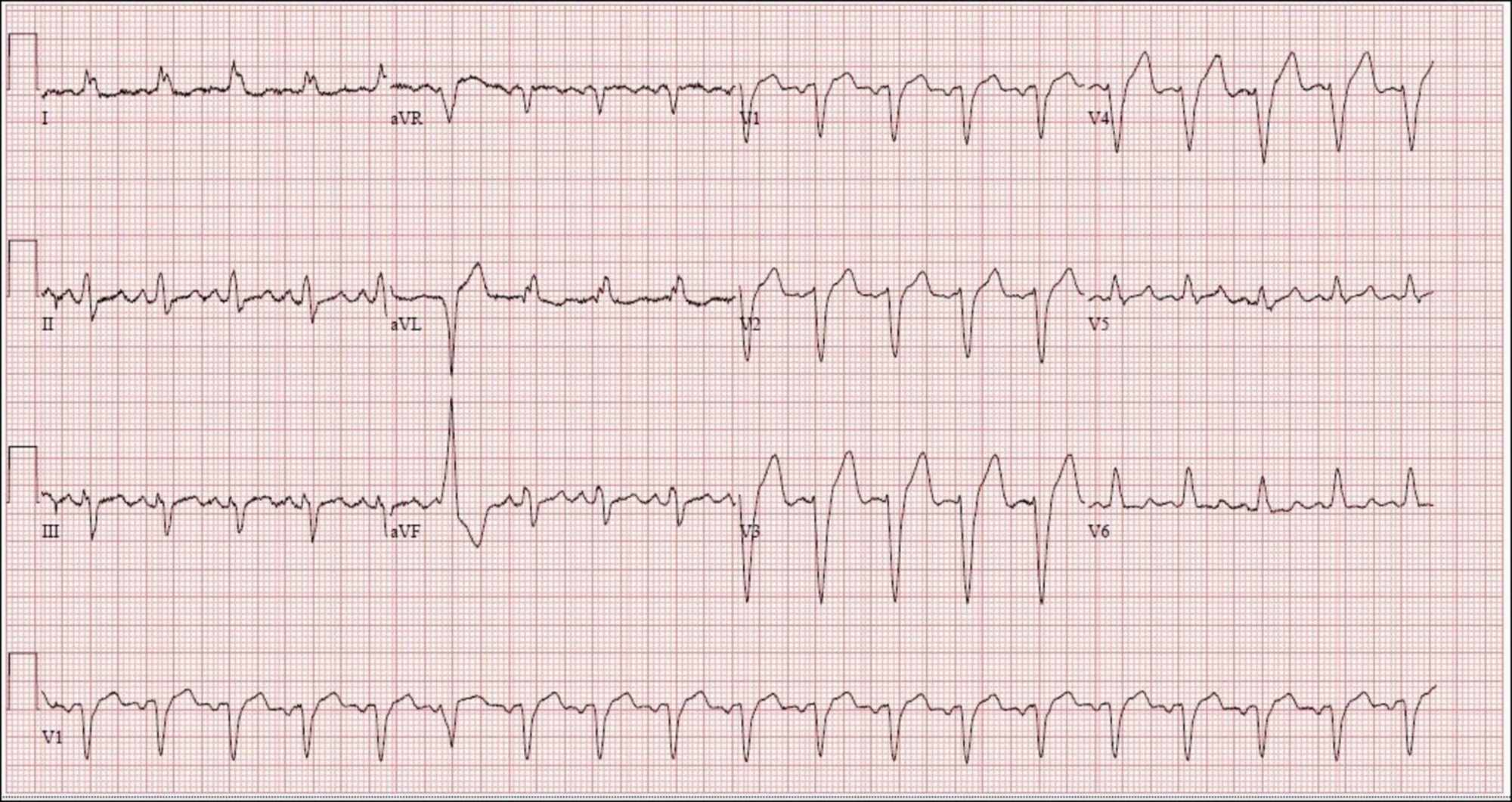 Cureus | Atypical Presentation of Spontaneous Coronary Artery Dissection