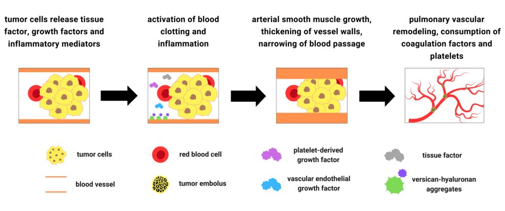 Summary-of-the-pathogenesis-of-pulmonary-tumor-thrombotic-microangiopathy