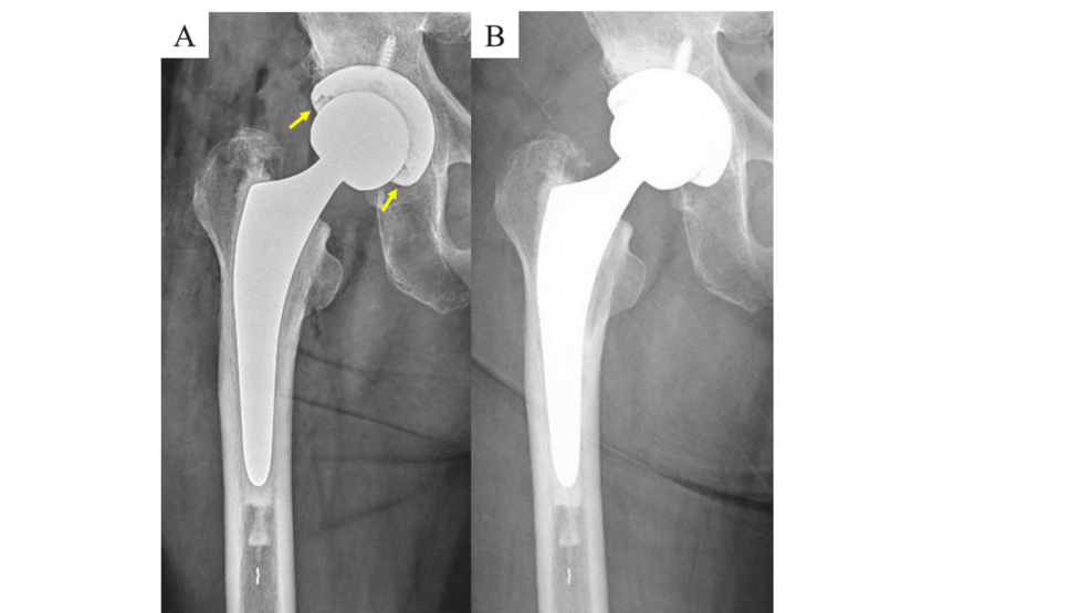 Foreign Body Entrapment on the Bearing Surface in Total Hip 