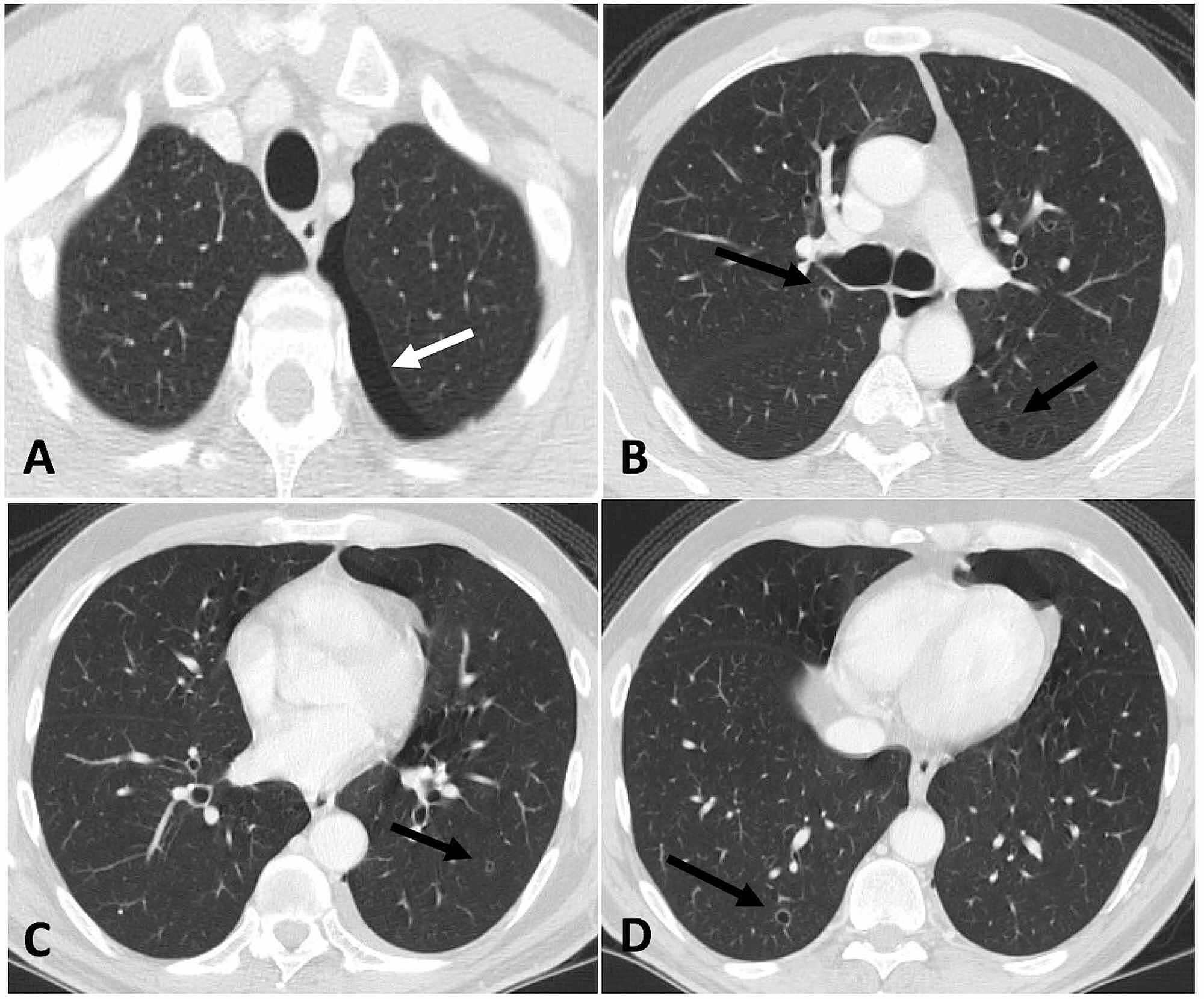 Cureus | Sunitinib: An Unusual Cause of Pneumothorax in a Patient With ...