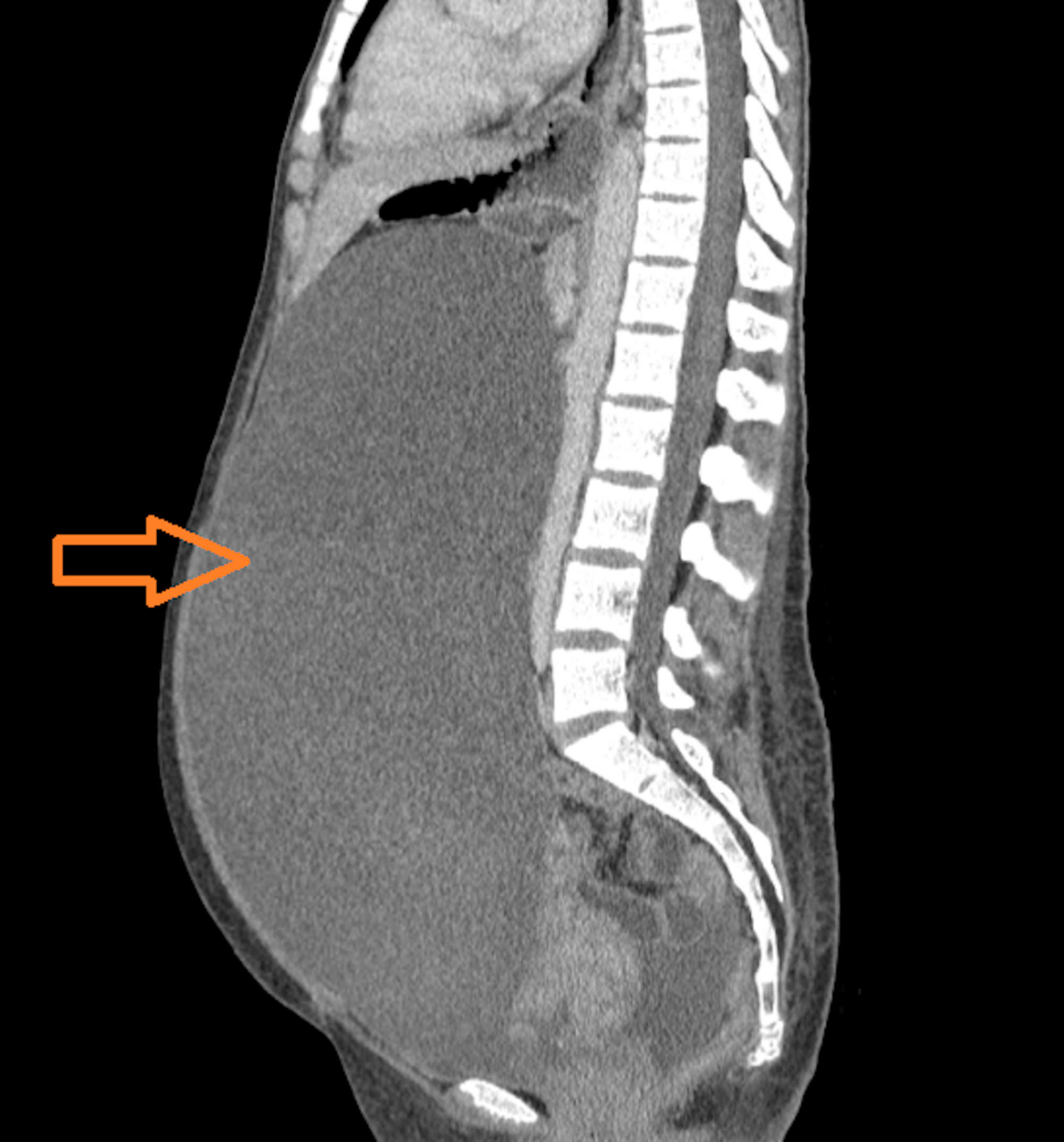 Cureus Gone But Not Forgotten Ovarian Metastasis From A Colon Carcinoma In A 19 Year Old Female