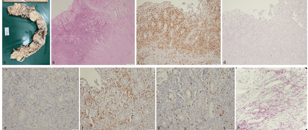 Primary Intestinal NK/T-cell Lymphoma Masquerading as Crohn's Disease: A Report of Two Cases