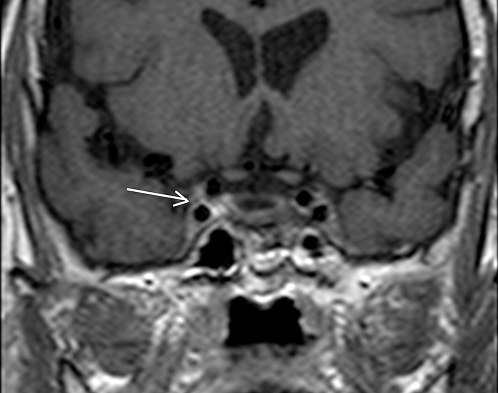 Cavernous-sinus-thrombophlebitis:-coronal-post-contrast-T1WI-(arrow)-shows-differential-enhancement-of-the-right-cavernous-sinus,-suggestive-of-cavernous-sinus-thrombophlebitis