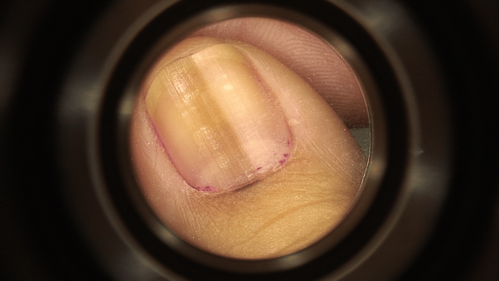 Dermoscopic-image-of-the-melanonychia-after-the-first-slow-growth.-A-micro-Hutchinson-sign-is-noted. Dermoscopic-image-of-the-melanonychia-after-the-first-slow-growth.-A-micro-Hutchinson-sign-is-noted.