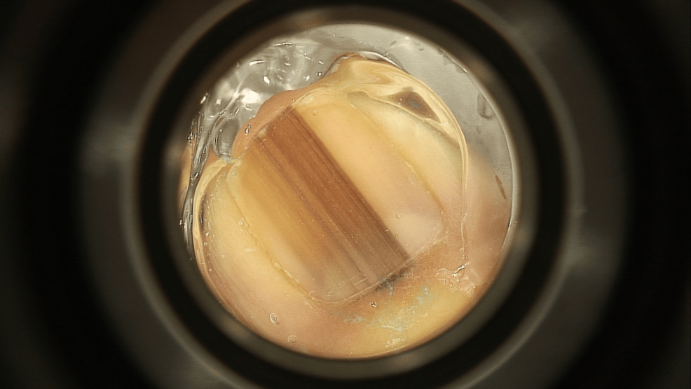 Dermoscopic-image-of-the-melanonychia-after-the-second-rapid-growth-and-malignant-transformation.-Note-the-heterogeneous-longitudinal-black-brown-lines-of-irregular-thickness-and-the-positive-Hutchinson-sign. Dermoscopic-image-of-the-melanonychia-after-the-second-rapid-growth-and-malignant-transformation.-Note-the-heterogeneous-longitudinal-black-brown-lines-of-irregular-thickness-and-the-positive-Hutchinson-sign.