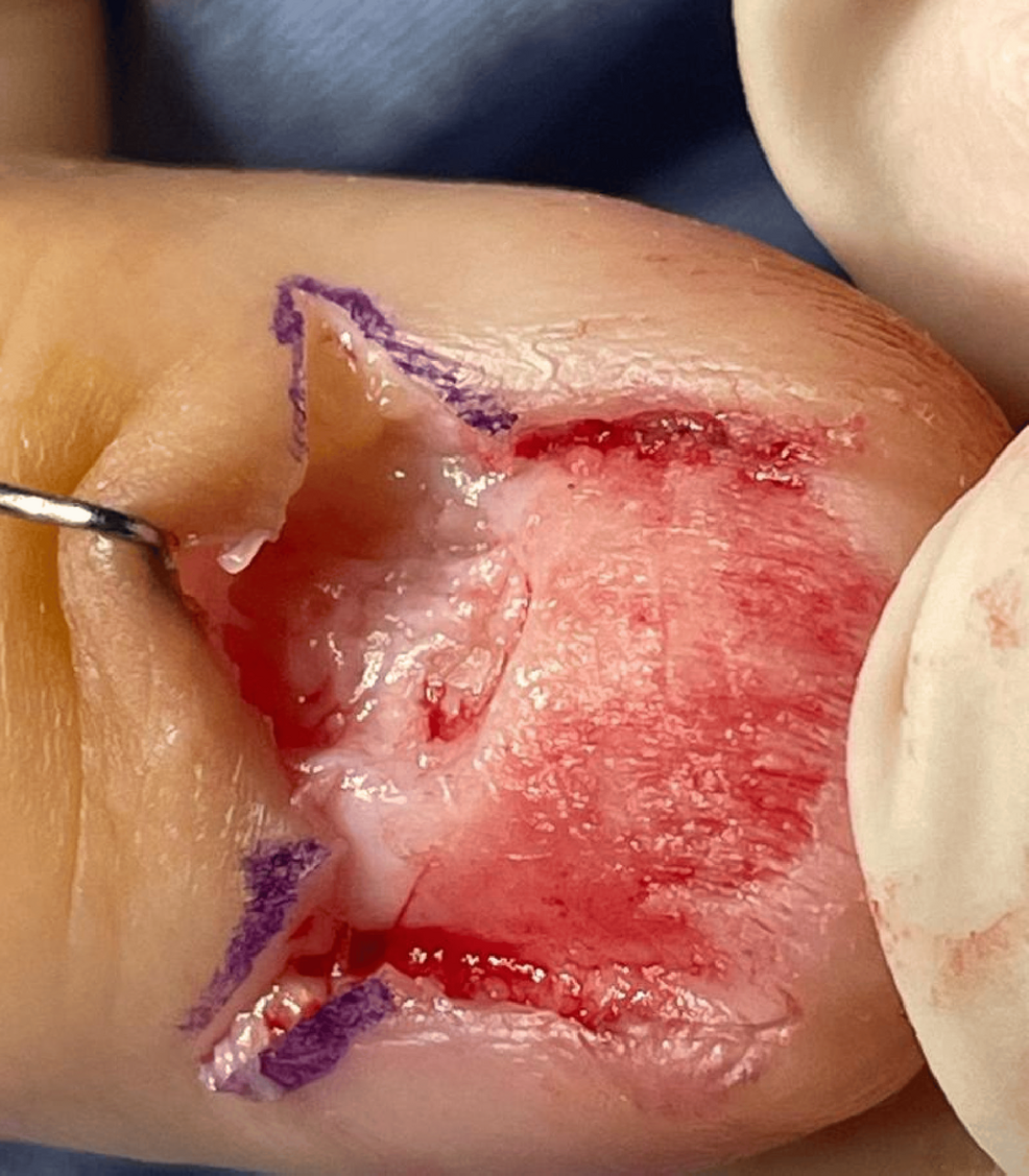 Surgical-excision-of-the-melanonychia Surgical-excision-of-the-melanonychia