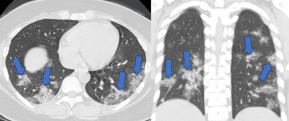 Patchy-consolidation-in-bilateral-lungs Patchy-consolidation-in-bilateral-lungs
