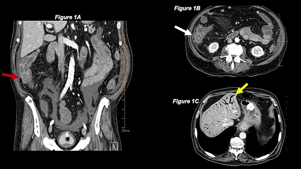 CT-of-the-abdomen-revealing-the-site-of-neutropenic-enterocolitis-and-portal-venous-gas