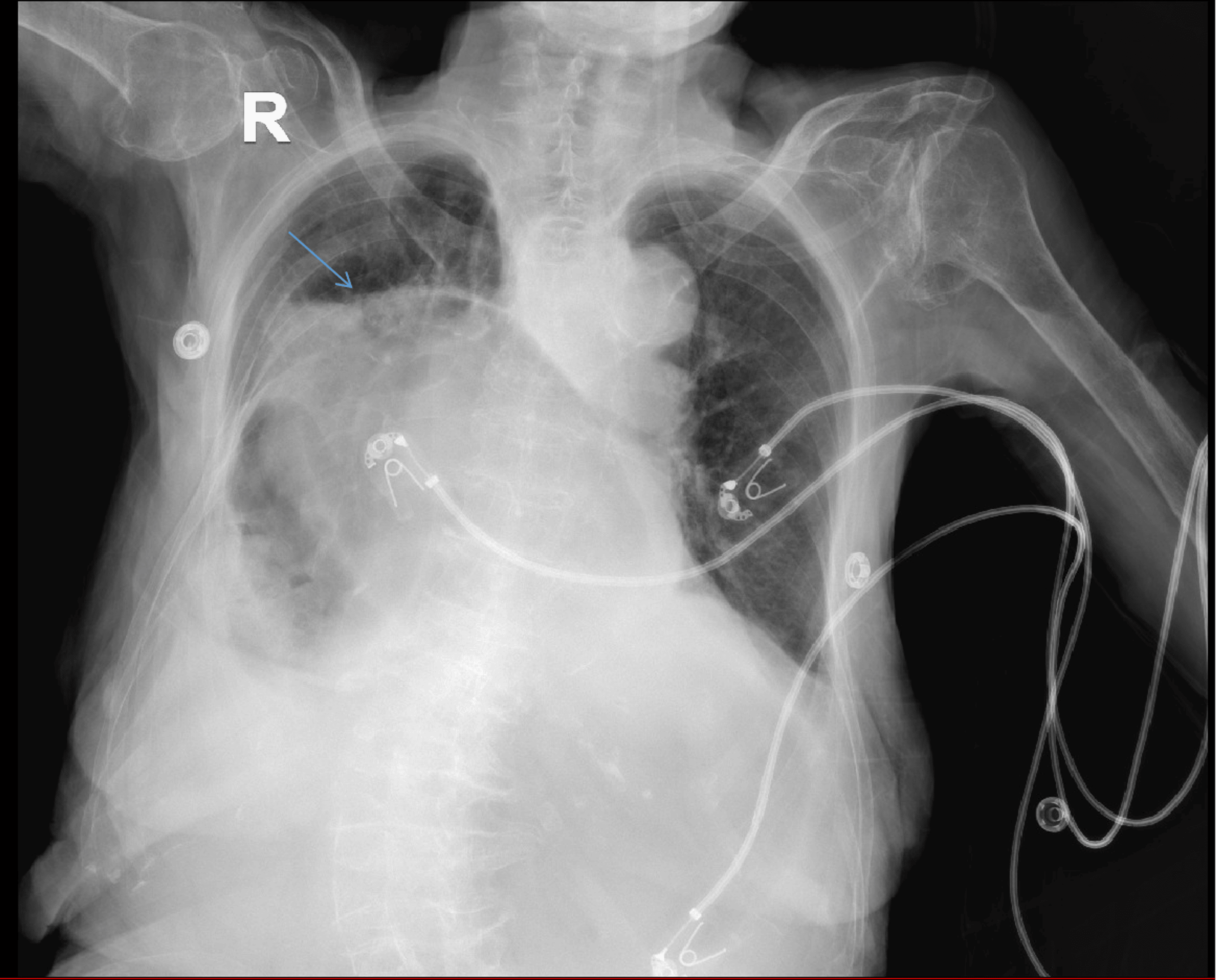 Hiatal Hernia in an Elderly Patient Complicated by Upper Gastroesophageal  Bleeding, Pulmonary Embolism, and Respiratory Failure: A Case Report