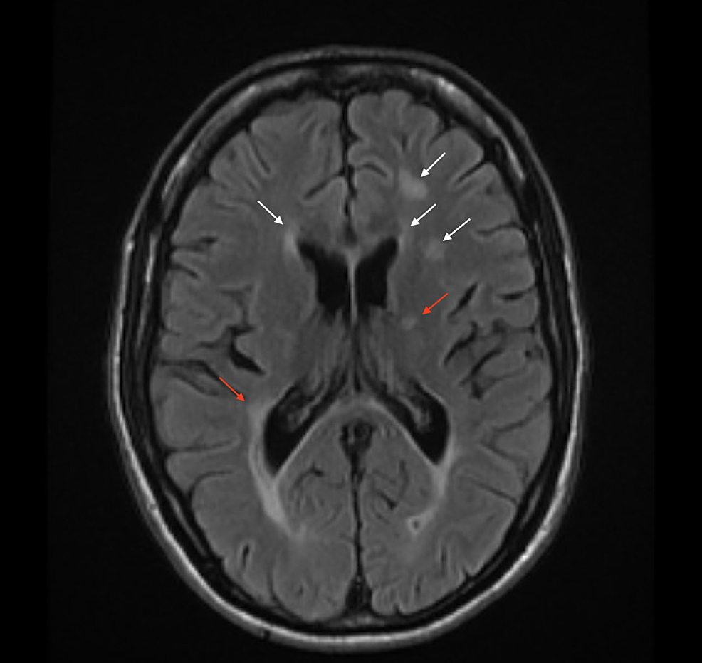 Axial-T2-flair-magnetic-resonance-imaging-(MRI)-of-the-brain-revealing-periventricular-demyelinating-process-(white-arrows)-and-white-matter-inflammatory-changes-around-the-perimedullary-veins,-known-as-Dawson-Fingers-(red-arrows)-consistent-with-multiple-sclerosis