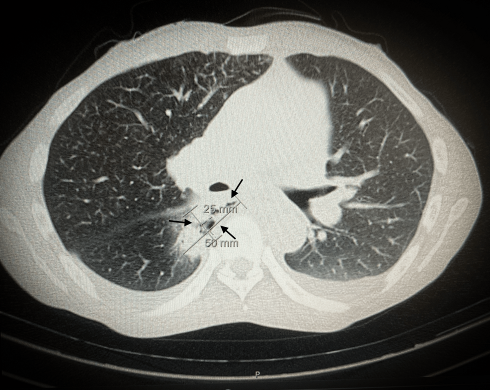 CT-scan-showing-a-fistulous-tract-extending-towards-the-right-sided-paravertebral-collection-containing-both-fluid-and-air-(arrows)