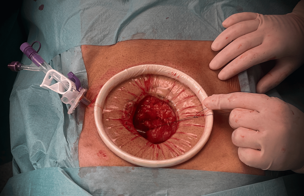 Open-gastrostomy-through-a-supraumbilical-midline-incision