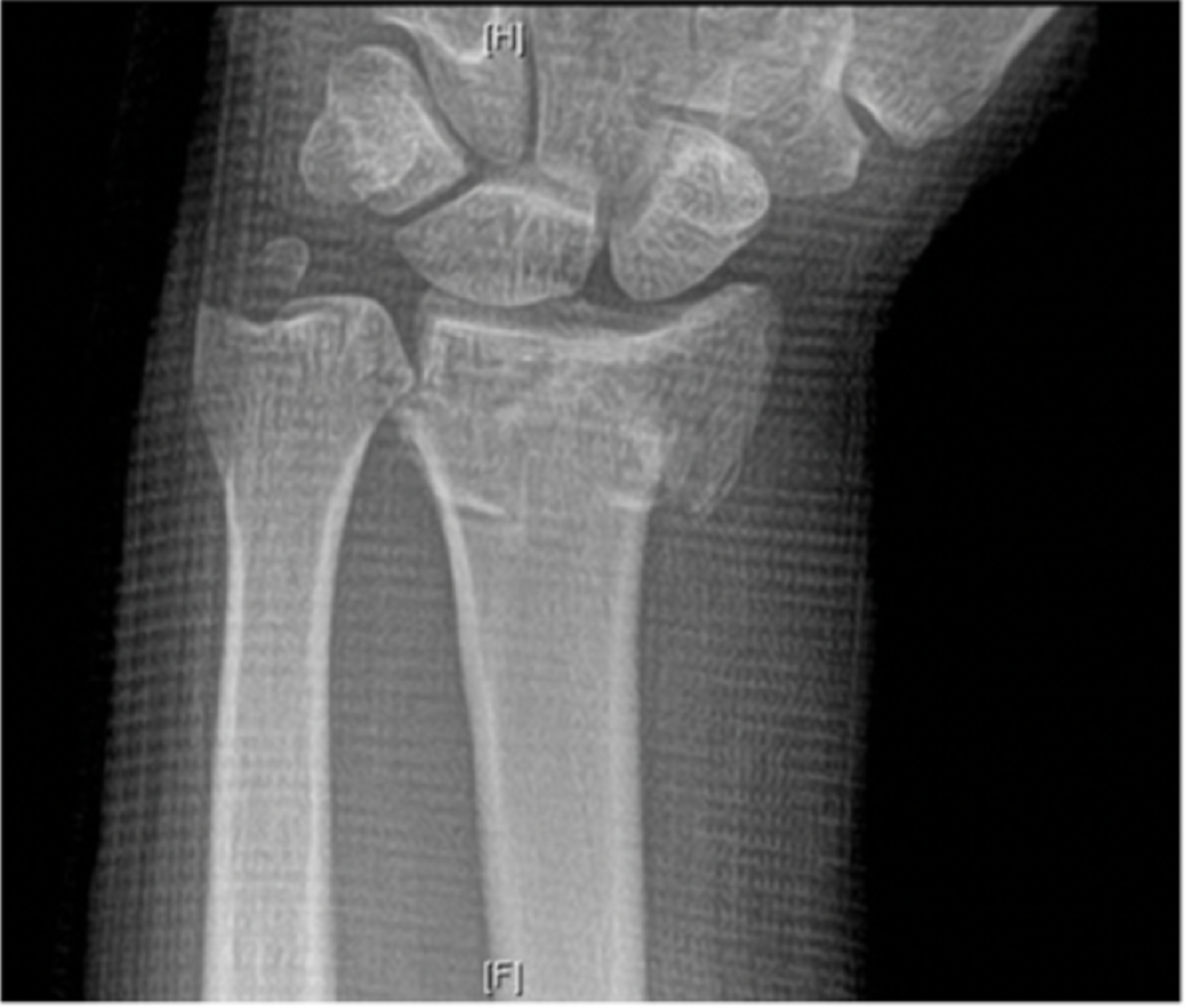 wrist distal radius fracture